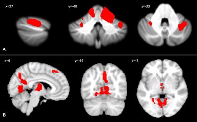 Cerebello-Cortical Alterations Linked to Cognitive and Social Problems in Patients With Spastic Paraplegia Type 7: A Preliminary Study